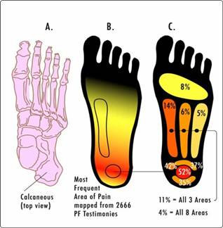 Glucosamine on sale plantar fasciitis